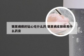 银屑病痒的钻心吃什么药 银屑病皮肤痒用什么药膏