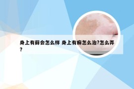 身上有藓会怎么样 身上有癣怎么治?怎么弄?