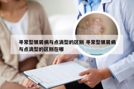 寻常型银屑病与点滴型的区别 寻常型银屑病与点滴型的区别在哪