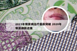 2023年银屑病治疗最新突破 2020年银屑病新进展