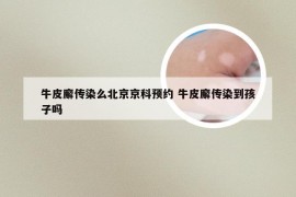 牛皮廨传染么北京京科预约 牛皮廨传染到孩子吗