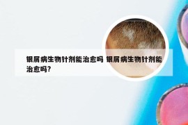 银屑病生物针剂能治愈吗 银屑病生物针剂能治愈吗?