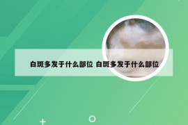 白斑多发于什么部位 白斑多发于什么部位