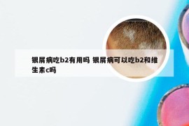 银屑病吃b2有用吗 银屑病可以吃b2和维生素c吗