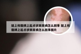 腿上和胳膊上起点状银屑病怎么回事 腿上和胳膊上起点状银屑病怎么回事图片