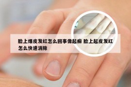 脸上爆皮发红怎么回事像起癣 脸上起皮发红怎么快速消除