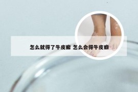 怎么就得了牛皮廨 怎么会得牛皮癖