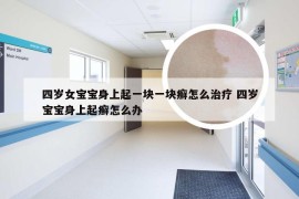 四岁女宝宝身上起一块一块癣怎么治疗 四岁宝宝身上起癣怎么办