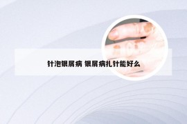 针泡银屑病 银屑病扎针能好么