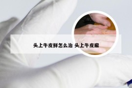 头上牛皮鲜怎么治 头上牛皮廨