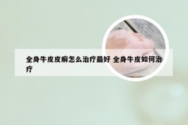 全身牛皮皮癣怎么治疗最好 全身牛皮如何治疗