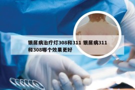 银屑病治疗灯308和311 银屑病311和308哪个效果更好