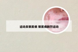 运动员银屑病 银屑病剧烈运动