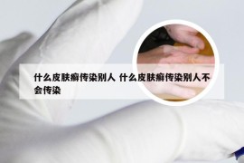 什么皮肤癣传染别人 什么皮肤癣传染别人不会传染