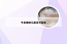 牛皮癣掉几层皮才能好