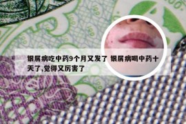 银屑病吃中药9个月又发了 银屑病喝中药十天了,觉得又厉害了