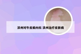 滨州对牛皮癣内科 滨州治疗皮肤病