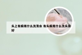 头上有癣用什么洗发水 有头癣用什么洗头膏好