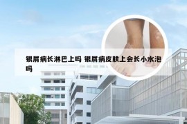 银屑病长淋巴上吗 银屑病皮肤上会长小水泡吗