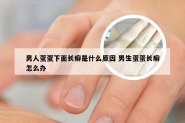 男人蛋蛋下面长癣是什么原因 男生蛋蛋长癣怎么办