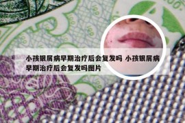 小孩银屑病早期治疗后会复发吗 小孩银屑病早期治疗后会复发吗图片