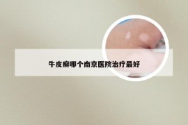 牛皮癣哪个南京医院治疗最好