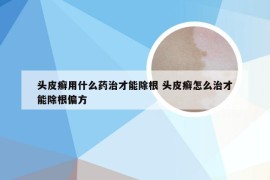 头皮癣用什么药治才能除根 头皮癣怎么治才能除根偏方