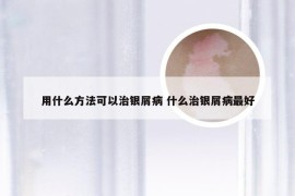 用什么方法可以治银屑病 什么治银屑病最好