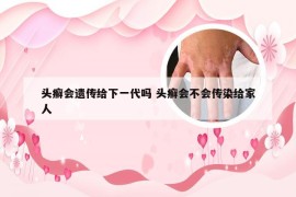 头癣会遗传给下一代吗 头癣会不会传染给家人