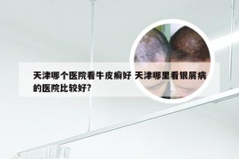 天津哪个医院看牛皮癣好 天津哪里看银屑病的医院比较好?