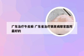 广东治疗牛皮癣 广东省治疗银屑病那家医院最好的