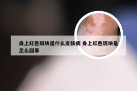 身上红色斑块是什么皮肤病 身上红色斑块是怎么回事