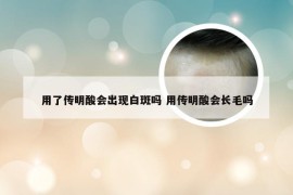 用了传明酸会出现白斑吗 用传明酸会长毛吗