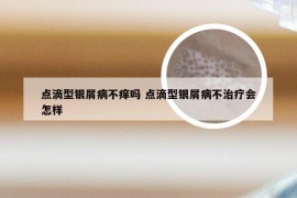 点滴型银屑病不痒吗 点滴型银屑病不治疗会怎样