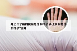 身上长了癣的视频是什么样子 身上长癣是什么样子?图片