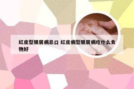 红皮型银屑病忌口 红皮病型银屑病吃什么食物好