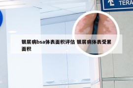 银屑病bsa体表面积评估 银屑病体表受累面积