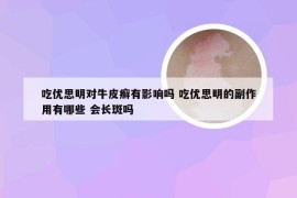 吃优思明对牛皮癣有影响吗 吃优思明的副作用有哪些 会长斑吗