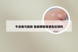 牛皮癣与股藓 股癣跟银屑病有区别吗