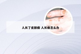 人长了皮肤癣 人长癣怎么办