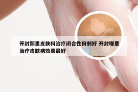 开封那里皮肤科治疗闭合性粉刺好 开封哪里治疗皮肤病效果最好