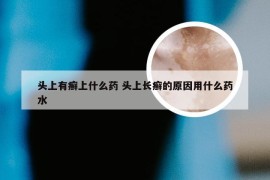 头上有癣上什么药 头上长癣的原因用什么药水