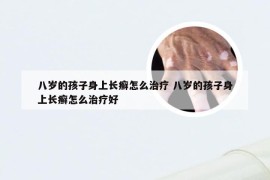 八岁的孩子身上长癣怎么治疗 八岁的孩子身上长癣怎么治疗好