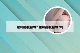 银屑病谁治得好 银屑病谁治得好啊