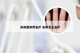 白斑是如何治疗 白斑怎么治疗