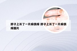 脖子上长了一片癣很痒 脖子上长了一片癣很痒图片