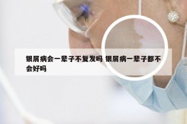 银屑病会一辈子不复发吗 银屑病一辈子都不会好吗