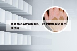 四肢有红色皮癣像烟头一样 四肢出现红色斑块很痒