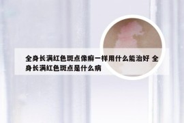 全身长满红色斑点像癣一样用什么能治好 全身长满红色斑点是什么病