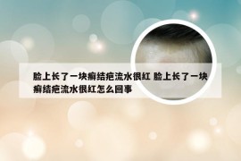 脸上长了一块癣结疤流水很红 脸上长了一块癣结疤流水很红怎么回事